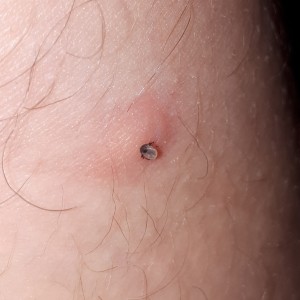 Kleines Mitbringsel vom Extremwandern...